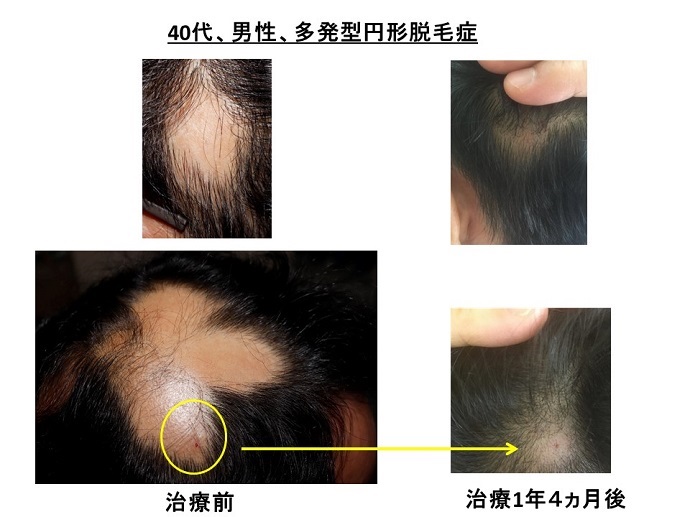 汎発性脱毛　名医